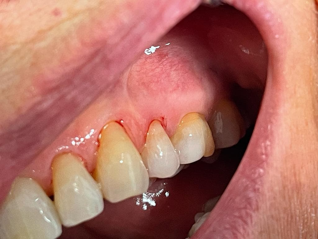 Efter behandling – tandborstningsskador